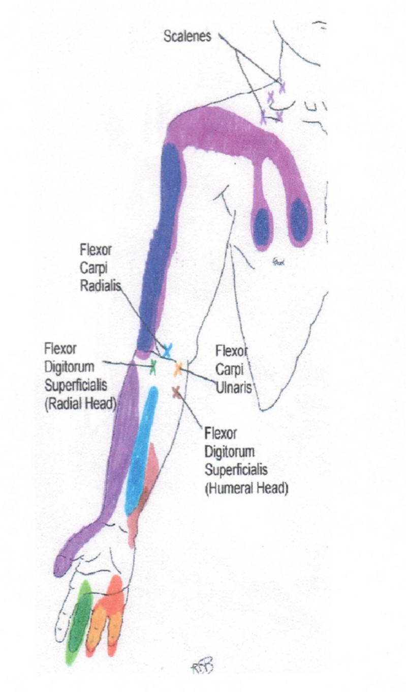 Trigger Point Chart Legs