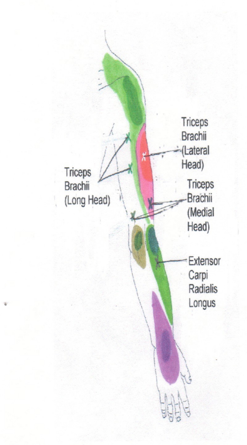 Shoulder Trigger Point Chart